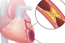 Chụp động mạch vành qua ống thông