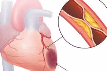 Chụp động mạch vành qua ống thông