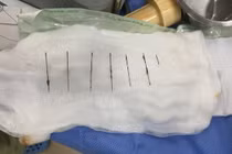 Bị stress tự dùng kim khâu đâm vào cơ thể 