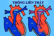 Cách điều trị các thể bệnh thông liên