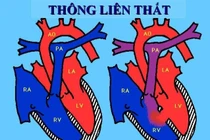 Cách điều trị các thể bệnh thông liên