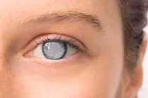 Tiểu đường + huyết áp cao= đục thủy tinh thể 