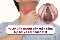 Polyp dây thanh và cách khắc phục hiệu quả từ thảo dược