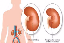 Điều trị hội chứng thận hư