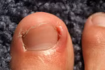 Tý mất chân vì đắp đinh lăng trị chín mé