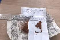 Suy gan cấp do bôi thuốc cam trị nhiệt miệng