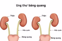 U bàng quang, tinh hoàn ở trẻ