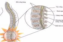 Biểu hiện của đau lưng do nhiễm khuẩn cột sống