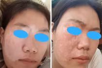 Ghép tế bào gốc tự thân điều trị bạch biến