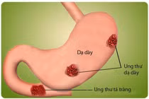 Siêu âm nội soi giúp chẩn đoán giai đoạn ung thư đường tiêu hóa 
