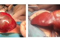 Các bác sĩ Bệnh viện Nhi đồng 1 TPHCM cắt u gan cho trẻ sơ sinh