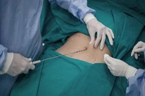 Hút mỡ bụng kỹ thuật viên thiếu kinh nghiệm dễ hỏng tạng 