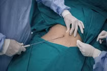 Hút mỡ bụng kỹ thuật viên thiếu kinh nghiệm dễ hỏng tạng 