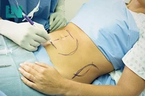 Ưu nhược điểm của hút mỡ bụng