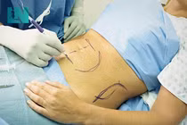 Ưu nhược điểm của hút mỡ bụng