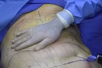 Sau hút mỡ bụng bị lồi, lõm...