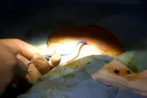 Lấy sỏi gan qua da