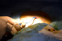 Lấy sỏi gan qua da