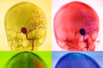 Các phương pháp chẩn đoán mạch máu não