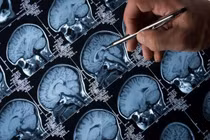 Sán dây sống 20 năm trong não?