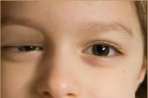 Tại sao sụp mí?