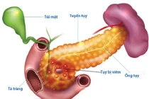 70% viêm tụy liên quan đến rượu bia