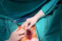 Can thiệp chỉnh sửa bộ phận sinh dục