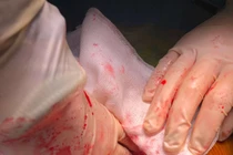 Chủ quan đau bụng cẩn thận thủng tạng rỗng nguy hiểm