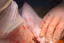 Chủ quan đau bụng cẩn thận thủng tạng rỗng nguy hiểm