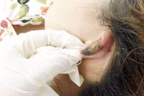 Hoại tử mũi, nát ngực vì làm đẹp đón Tết