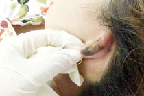 Hoại tử mũi, nát ngực vì làm đẹp đón Tết