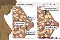 Áp xe vú do tắc tia sữa