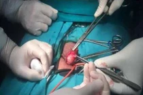 Ngứa bao quy đầu thành ung thư dương vật