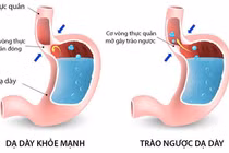 Xạ hình chẩn đoán trào ngược dạ dày-thực quản