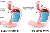 Xạ hình chẩn đoán trào ngược dạ dày-thực quản