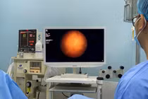 Ứng dụng laser trong điều trị ung thư bàng quang không xâm lấn cơ 