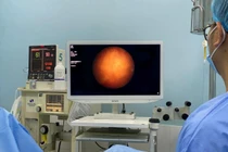 Ứng dụng laser trong điều trị ung thư bàng quang không xâm lấn cơ 