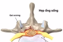 Hẹp ống sống do thoái hóa