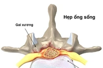 Hẹp ống sống do thoái hóa