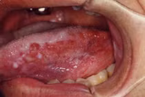 Các dạng tổn thương dễ gây ung thư lưỡi