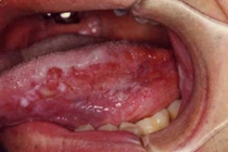 Các dạng tổn thương dễ gây ung thư lưỡi