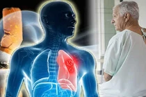 Ung thư phổi liệu bệnh nhân có quyền hy vọng?