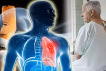 Ung thư phổi liệu bệnh nhân có quyền hy vọng?