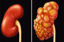 Dấu hiệu ung thư thận