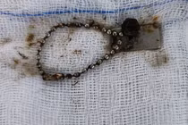  Trẻ thủng ruột vì nuốt nam châm 