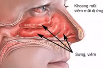 Kích thích huyệt tay điều trị viêm mũi dị ứng