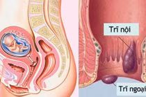 Nguy cơ mắc trĩ khi mang thai