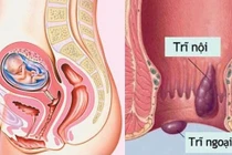 Nguy cơ mắc trĩ khi mang thai