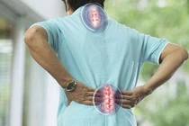 Cắt bảng sống trong vôi hóa cột sống