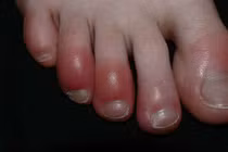 4 cách phòng tránh cước tay chân mùa lạnh